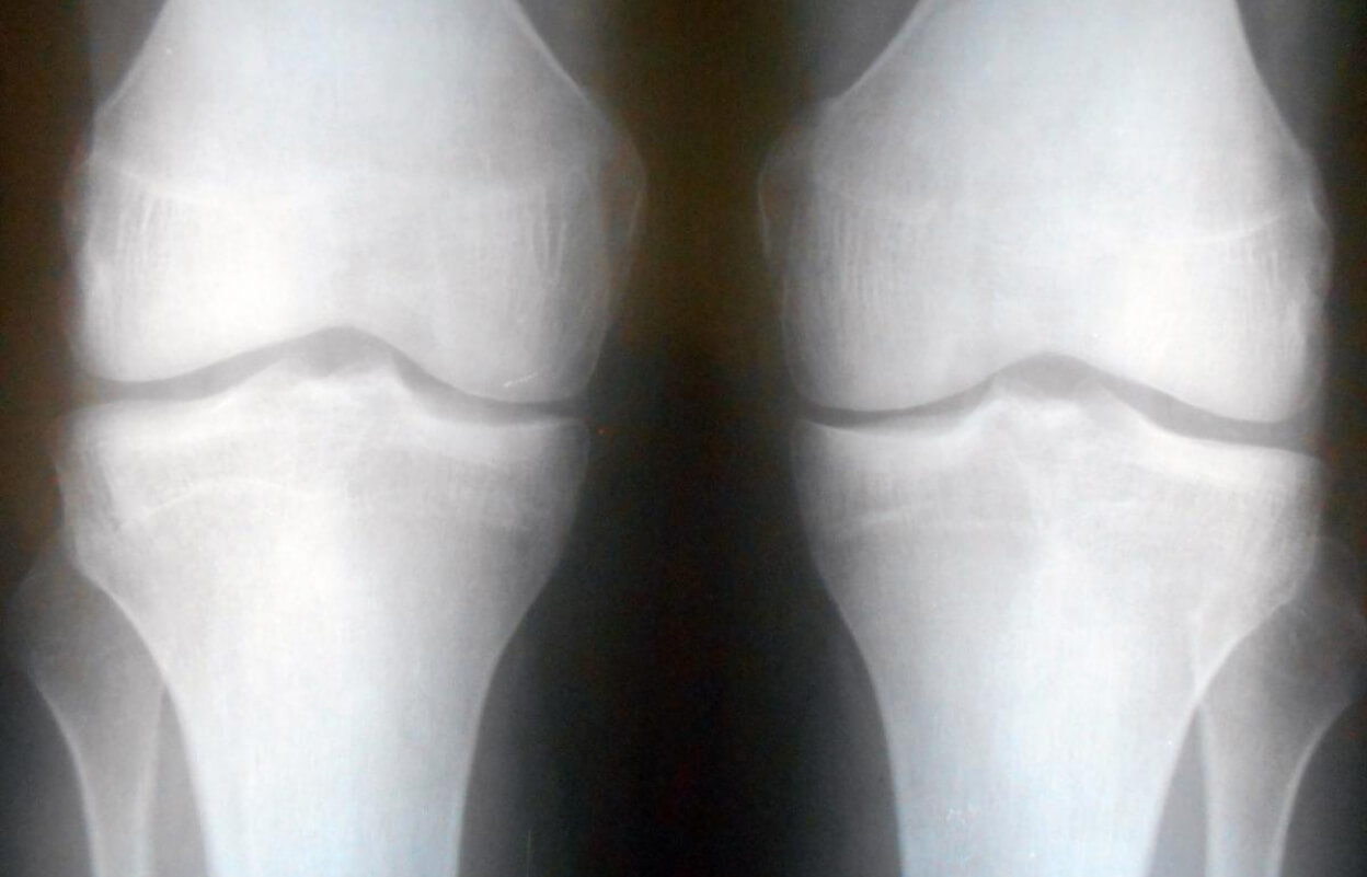 Рентгеновский снимок сустава с артрозом: остеофиты и сужение суставной щели