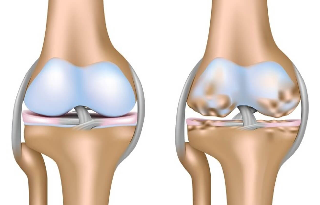 Сравнение здорового сустава и сустава с артрозом у собаки